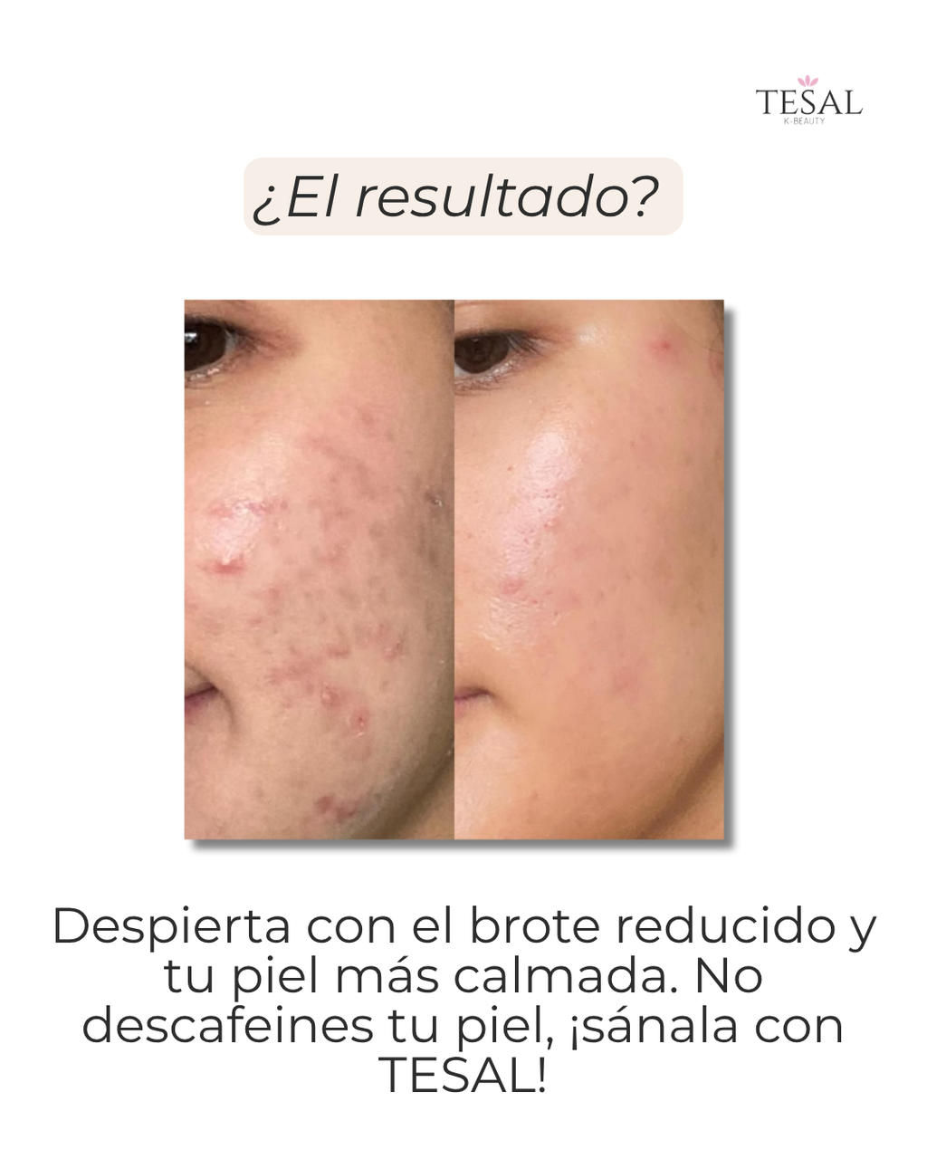 Kit SOS Antiacné: Control y Rescate Nocturno
