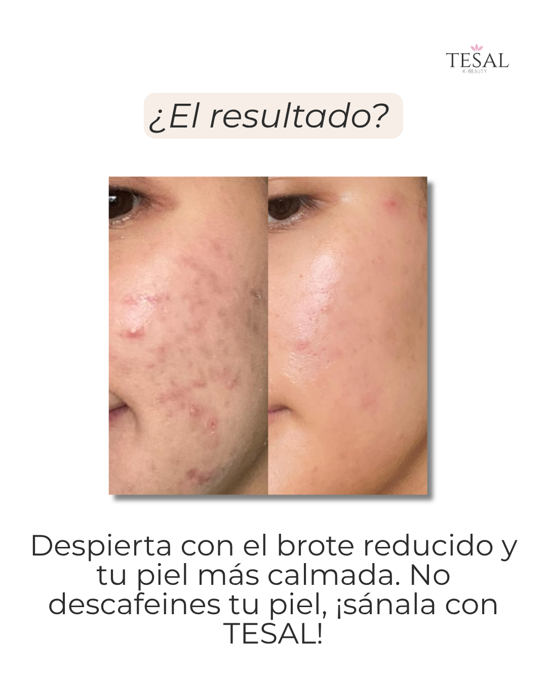 Kit SOS Antiacné: Control y Rescate Nocturno